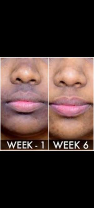 skin lightening cream