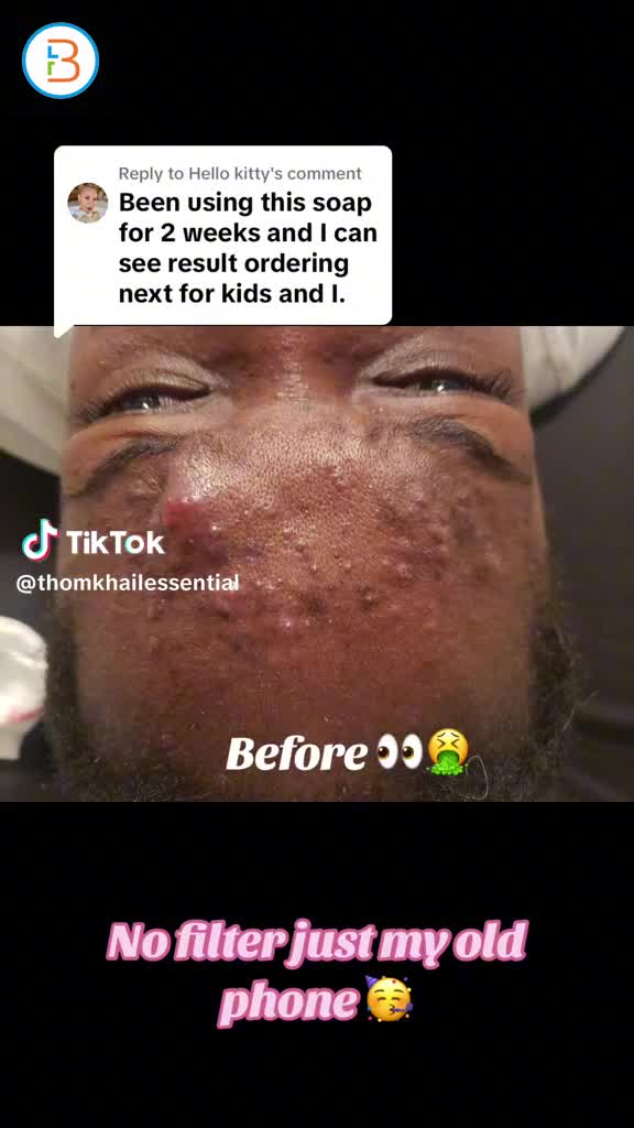 "Experience the natural glow with our tumeric soap 🧼 😱#TumericSoap #NaturalSkincare"